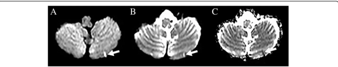 Fig. 2 MRI showing a patient with chronic SCCI, seen as hypointensity on DWI B1000 (a) and as hyperintensity on B0 images (b) and ADC map (c)Fig