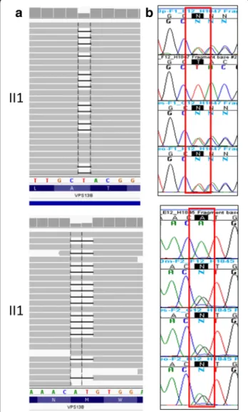 Fig. 2 a Integrative Genomics Viewer of short read alignment indicated the compound heterozygous variant identified by exome sequencing (100,479,778 T/ − ,100712001AT/ − ) in the VPS13B gene.