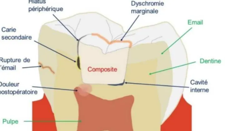 Figure 9 -   Dommages engendrés par le retrait de polymérisation et les contraintes  de contraction