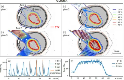 Figure 1. (a–d) Dose distributions calculated for plans 1 to 4 (glioma). Dose profiles are plotted in the healthy  tissue region (e, depth 3 cm) and in the target volume (f) for plans 3 and 4