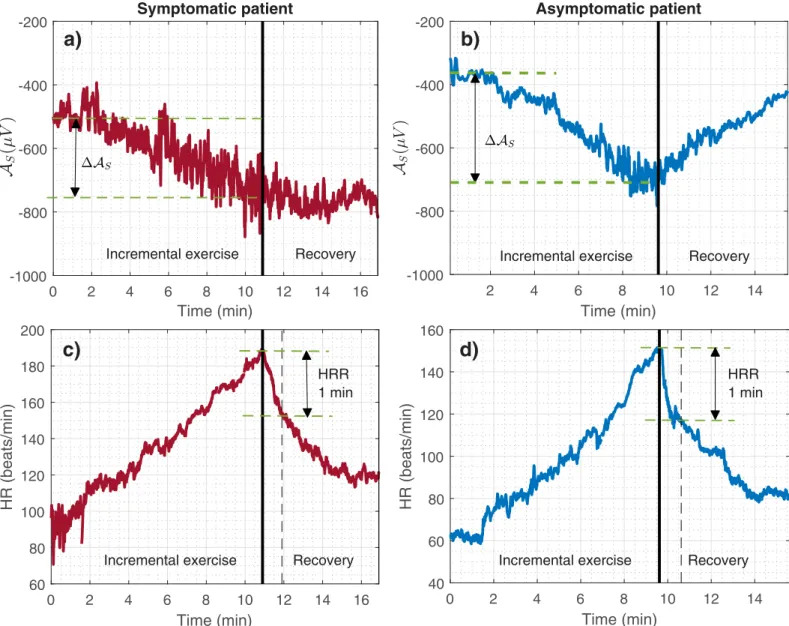Fig 2. a) and c) Temporal evolution of the S-wave amplitude (A S ) and heart rate (HR) during the exercise test for a male symptomatic patient; b) and d) for a male asymptomatic patient