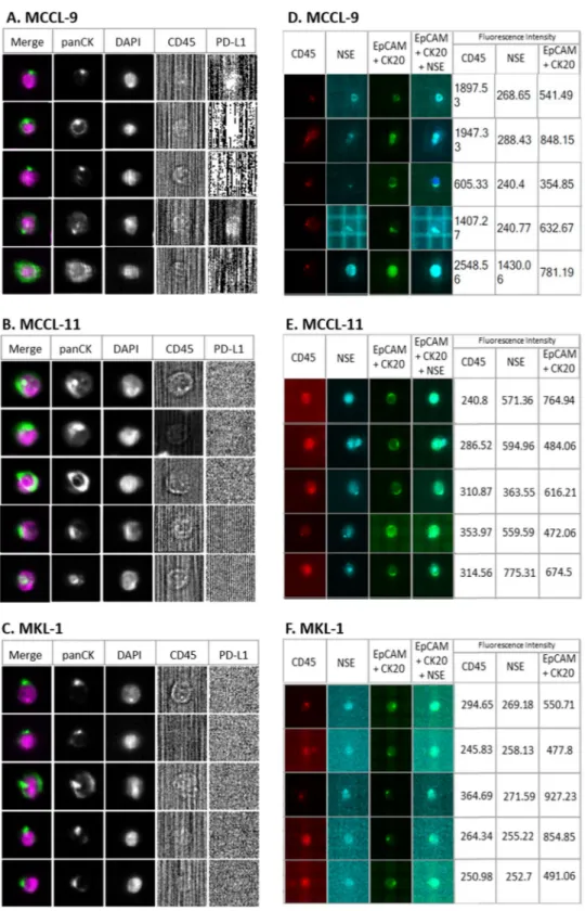 Figure 2.  Representative photos of MCC cells detected in spiking experiments. Detection of (A) MCCL-9,  (B) MCCL-11 and (C) MKL-1 cells added to blood from healthy donor using the CellSearch system; an  anti-PD-L1 antibody was added in the fourth channel 