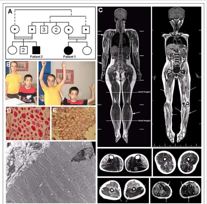 Figure 1 Clinical, histological and MRI features in the patients. (A) Pedigree of the consanguineous family of both ARCNM patients.