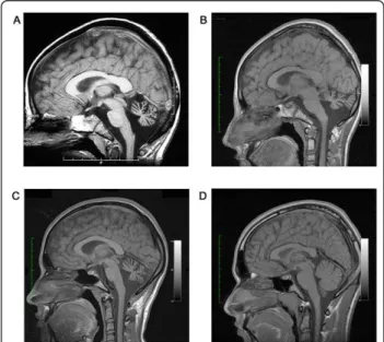 Figure 1 Brain T-1 weighted magnetic resonance imaging showing marked cerebellar atrophy in P1 at the age of 9 years (panel A) and 14 years (panel B), and in P2 at the age of 18 years (panel C)