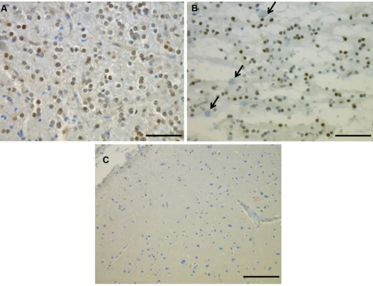 Figure 2: Phospho-FGFR1 protein expression detected by immunohistochemistry on two DNT cases: the  immunoreactivity was restricted to the glial compartment (A and B) especially the oligodendroglial-like cells in the  glial nodule (A) and the GNE (B)