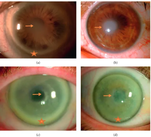 Figure 1: Slit-lamp photographs of Schnyder corneal dystrophy patients showing central opacities (arrows), midperipheral stromal haze, and peripheral arcus lipoides (stars) in most patients