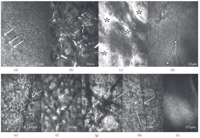 Figure 3: In vivo confocal microscopy images (400 × 400 μm) at diﬀerent scanning depths showing epithelial and stromal hyperreﬂective deposits and keratocyte damage in eyes with Schnyder dystrophy