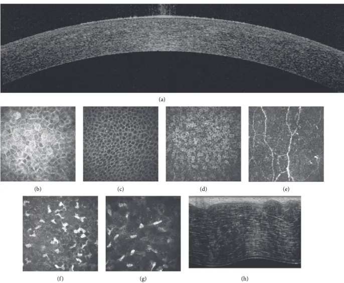 Figure 6: Spectral domain-optical coherence tomography (a), in vivo confocal microscopy (b–g), and ex vivo full-ﬁeld optical coherence tomography of normal human corneas