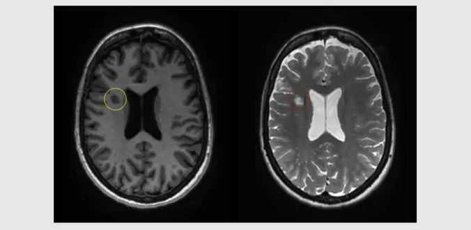 Figure 2. T1- and T2-weighted image of a patient with MS 