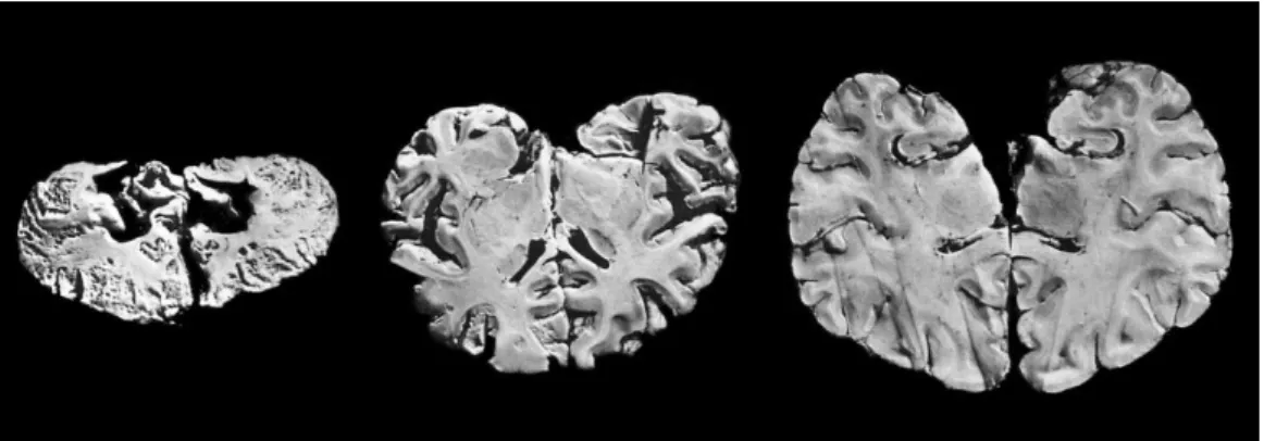 Figure 1-4: Echantillons de tissus cérébraux appartenant à des patients atteints  de la maladie de  Minamata  (à  gauche  et  au  centre)  illustrant  les  effets  dévastateurs  d’une  exposition  prolongée  au MeHg
