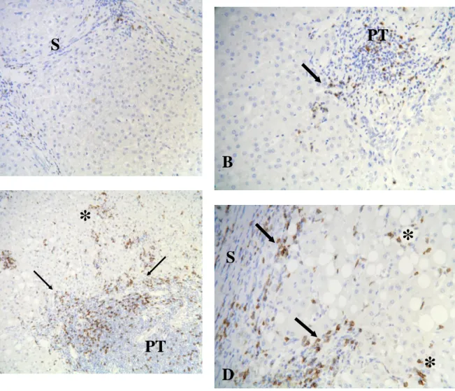 Figure  2  Immunohistology  of  CD8  expressing  cells  in  liver  of  chronic  viral  hepatitis  C  patients