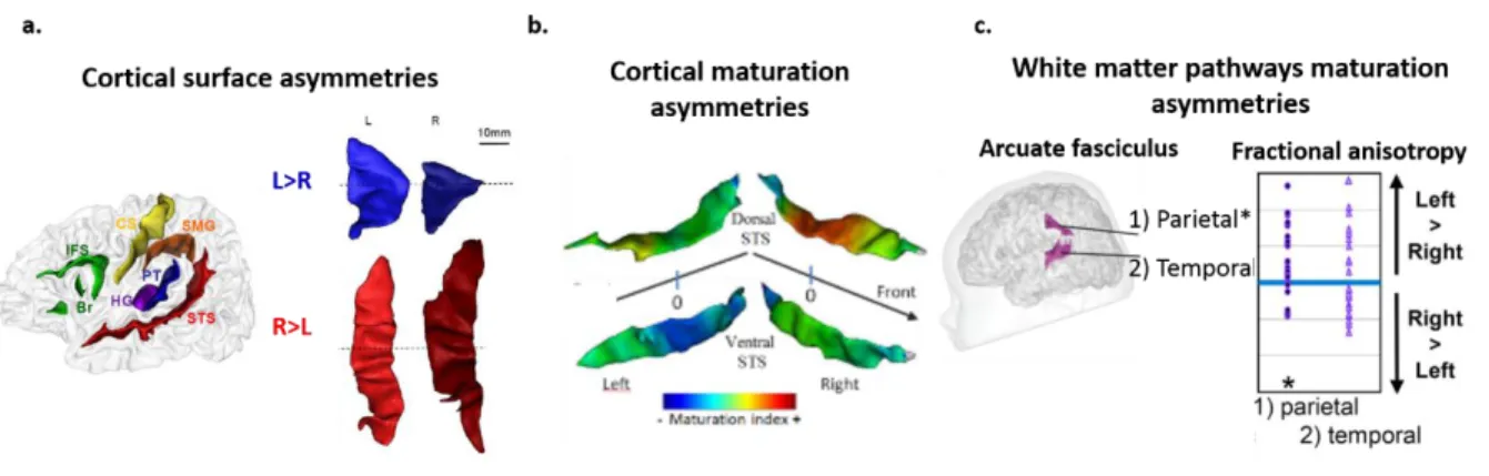 Figure 1.9. Structural asymmetries in the language network in infancy. a) Cortical surface asymmetries in Planum temporale (PT)  and Superior Temporal Sulcus (STS) , example of a 14 weeks old infant: PT is bigger in the left hemisphere, while STS is deeper