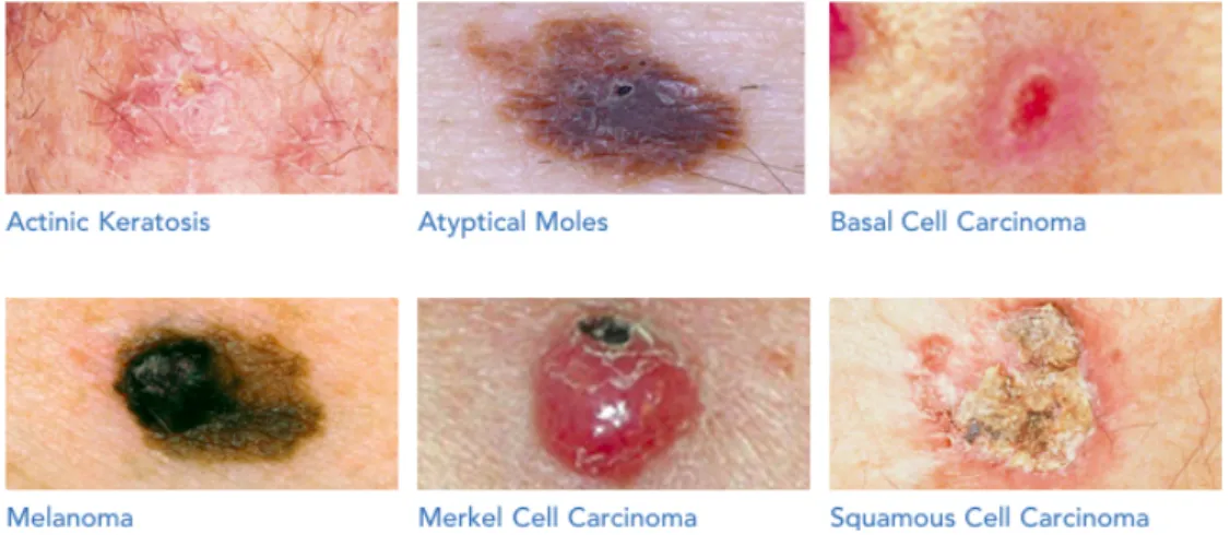 Figure 1.1: Different kinds of skin cancer classified by the Skin Cancer Foundation [2]