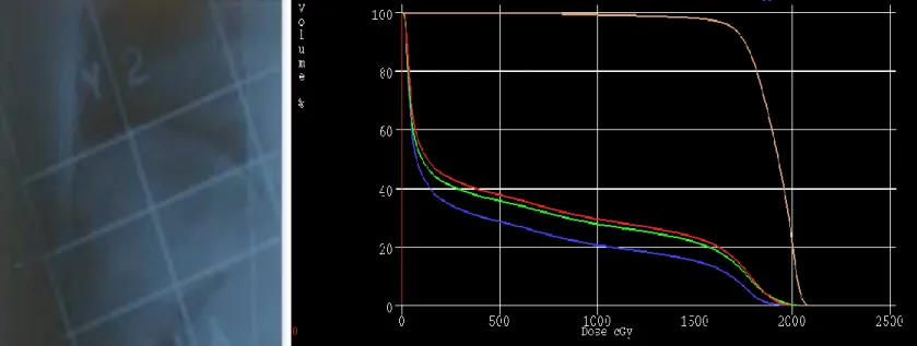 Figure 13. Exemple de planification 2D d’un traitement par radiothérapie à gauche, et d’un histogramme dose-volume  issu d’une planification 3D à droite (courbe beige correspondant à l’irradiation du volume cible, les courbes rouge, verte,  bleue correspon