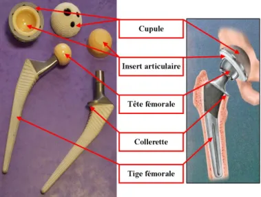 Figure 1.4 – Composants d’une proth` ese totale de hanche