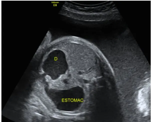 Fig 2-a. Distended hypopharynx caused by a lower esophageal atresia 32 + 2 WG revealing  esophageal atresia.