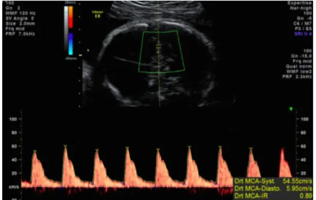 Fig 2-f. Systolic velocity in the middle cerebral artery at 30WG