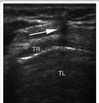 Figure 3 Real-time ultrasound guidance using an out-of-plane approach. Progression of the needle is determined by a distinct acoustic shadow (arrow)