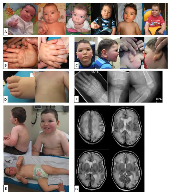 Figure 1. Weaver syndrome proband with polymicrogyria described in this study. A: Proband 5 is shown at 2, 4, 6, 8, 12, and 19 months