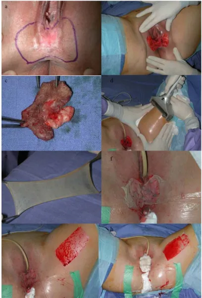 Figure 1: Skinning vulvectomy with split-thickness skin graft surgical procedure 