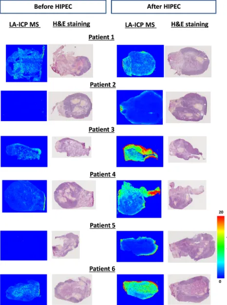 Figure 2: LA-ICP MS quantitative images of cryosections of the ovaries of the six  pa-tients