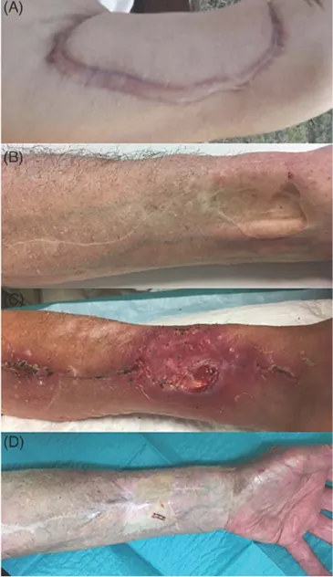 FIGURE  4  Wound complication examples. A, Hypertrophie scar  after keystone flap. B, skin trough