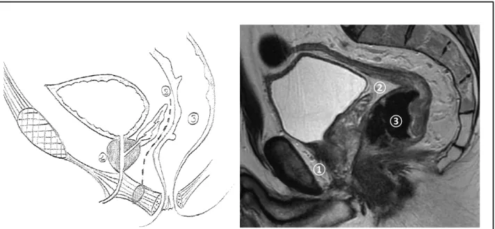 Figure 1  :  Vue  sagittale  schématique  et  en  IRM  du  pelvis  masculin  avec  le  carrefour  uro- uro-génital  prostatique  ①  situé  en  avant  des  vésicules  séminales  ②  et  de  l’aponévrose  péritonéo-prostatique  de  Denonvilliers  (ligne  poin
