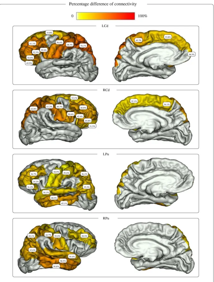 Figure 7. Percentage difference of connectivity for the striatum nuclei. The figure shows the percentage difference of connectivity between healthy subjects and HD patients, obtained for each nucleus of the striatum and cortical gyri belonging to the conne