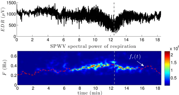 Fig 7. Representative example of respiration information. The upper panel represents an example of EDR series, calculated from the R-wave peak amplitudes of a specific patient