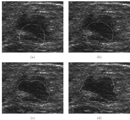 Fig. 2. Segmentation result on real echographic image representing a breast tumor with optimal regularization term λ = 100, with the agreement of the radiologist: (a) Initialization; (b) and (c) propagation; (d) convergence, in order to obtain the ﬁnal con