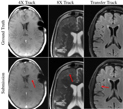 Figure 7: Examples of reconstruction hallucinations among challenge submissions. (left) A 4X submission from Neurospin generated a false vessel, possibly related to susceptibilities introduced by surgical staples
