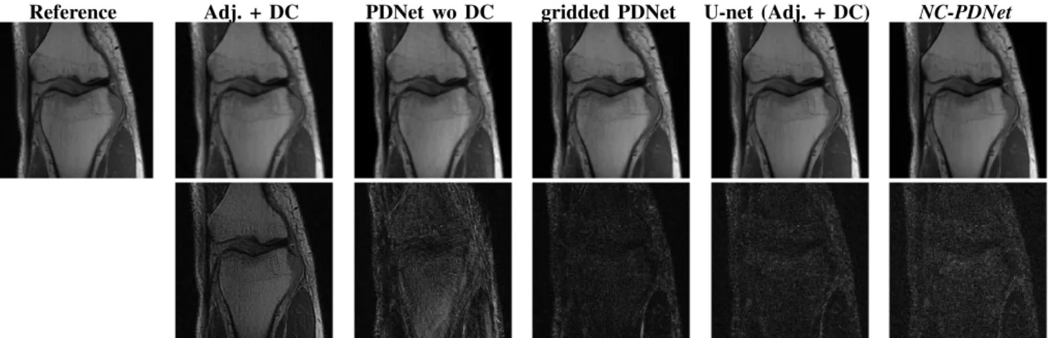 Fig. 3. 2D single-coil radial acquisition (knee fast MRI dataset): Reconstruction results for a specific slice (16th slice of file1001184, part of the validation set)