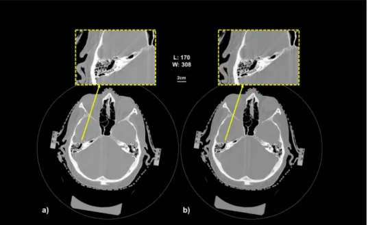 Table 2 summarizes the quantitative results obtained on the Catphan phantom for the central background ROI  (worth scenario for SNR or CNR considering the artifacts seen on Fig. 3)