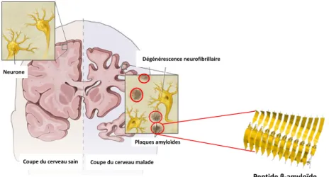 Figure 15. Illustration du dépôt des plaques amyloïdes dans le cerveau humain, mettant en  évidence la formation de feuillets β (la structure secondaire du β-amyloïde est tirée de : (Xiao 
