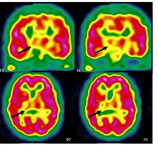 Figure 1: Cerebral SPECT showing a right thalamic hypoperfusion at the initial period of the patient history.