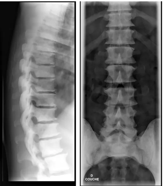 Figure 1 : hyperdensité osseuse diffuse et acquise  liée à une myélofibrose primitive