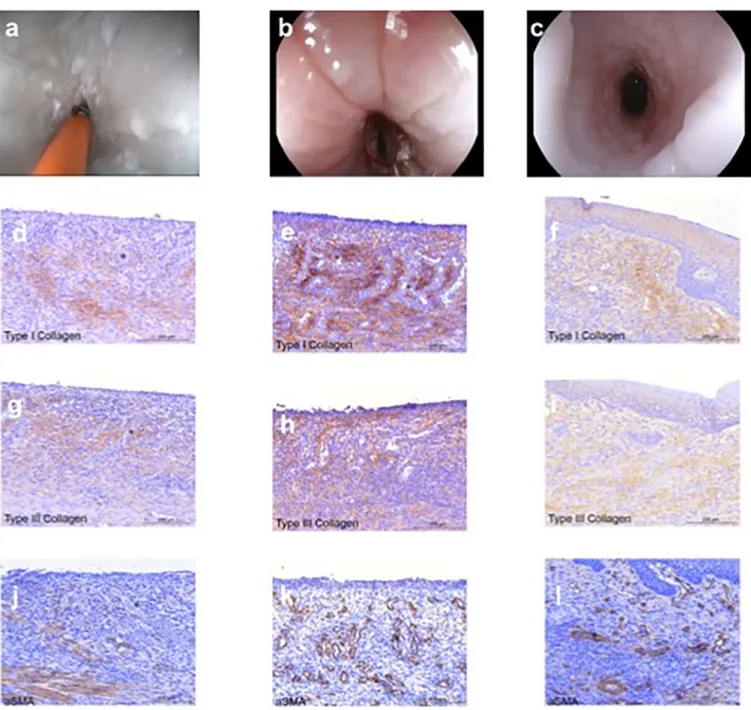 Fig 2. Endoscopic pictures for a control pig (a), a treated pig who developed an endoscopic stenosis (b) and a treated pig without stenosis at day 14 (c) and immunohistochemistry labelling of Collagen I (d, g, j), Collagen III (e, h, k) and Alpha-SMA (f, I