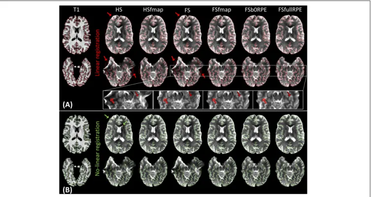 FIGURE 2 | Average b0 image of one subject linearly (A) and non-linearly (B) registered into the structural space, after distortion correction through the six pipelines.