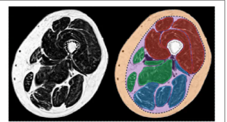 FIGURE 1 | Fat fraction map of a thigh of a patient with myotonic dystrophy type 1 (left) and corresponding segmentation of the principal regions of interest (right)