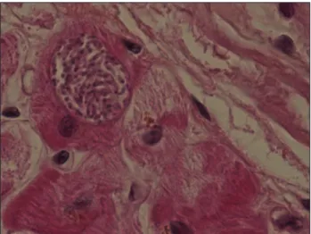 Figure 2. Deux kystes toxoplasmiques bien visibles au sein d’un infiltrat lymphoïde interstitiel et péri-vasculaire (coloration HES, grossissement x 250)
