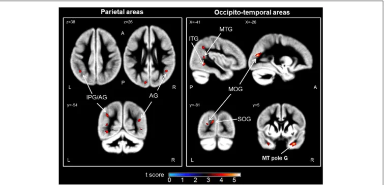 FIGURE 1 | Brain regions in which the low numerical transcoding (LNT) group showed significantly less gray matter volumes compared to the high numerical transcoding (HNT) group