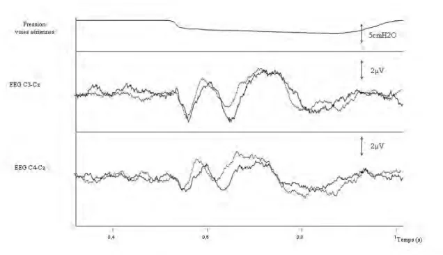 Figure  8.  Exemple  de  superposition  de  2  enregistrements  séquentiels  de  potentiels  évoqués  respiratoires  chez  un  sujet  sain,  lors  de  la  même  session  expérimentale