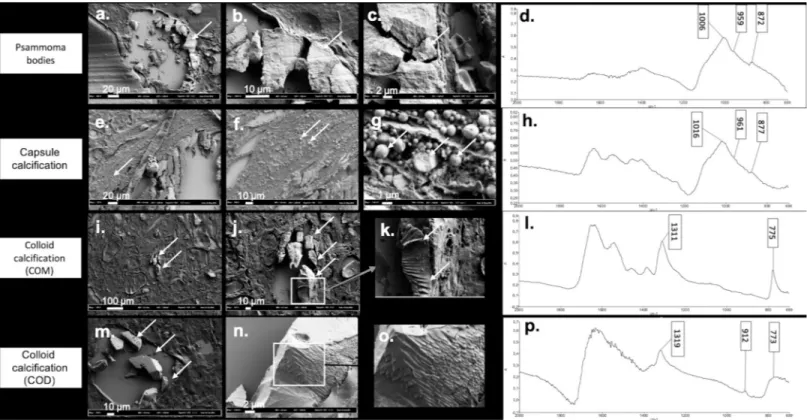 Fig 3. Illustration of the different patterns of crystals deposits in thyroid tissue using FE-SEM according to composition assessed by μFTIR spectrometry