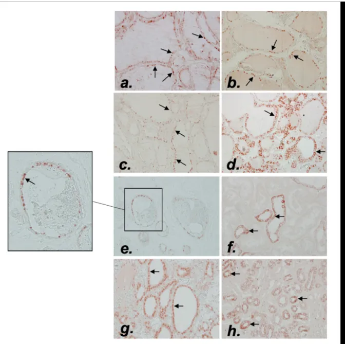 Fig 4. Immunochemistry of Ki67, RUNX2, OPN, CD44, TRPV5 and CaSR in thyroid sample. Representative illustration of Ki67 (a) (arrows indicating Ki67 positive cells), RUNX2 (b) (arrows indicating RUNX2 positive cells), OPN (c) (arrows indicating OPN positive