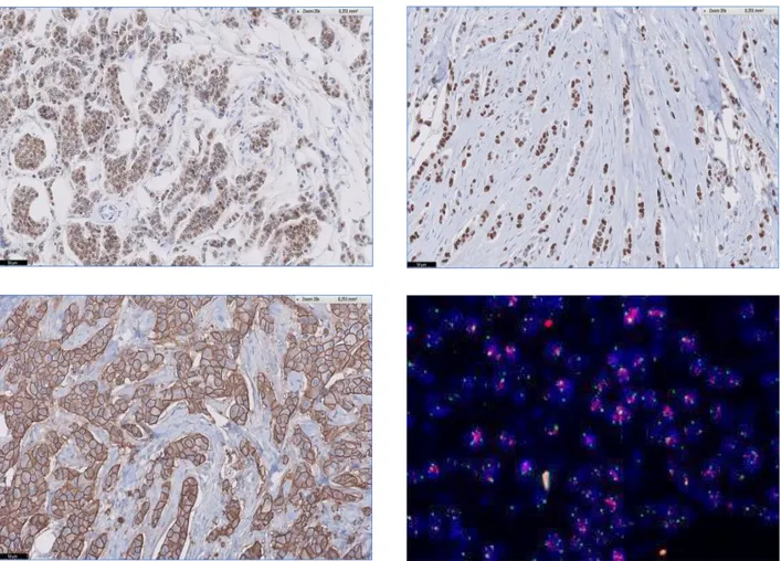 Figure 9 : Classification immunophénotypique habituelle des carcinomes mammaires infiltrants