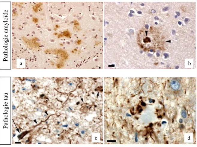 Figure 8. Lésions neuropathologiques dans la maladie d’Alzheimer 