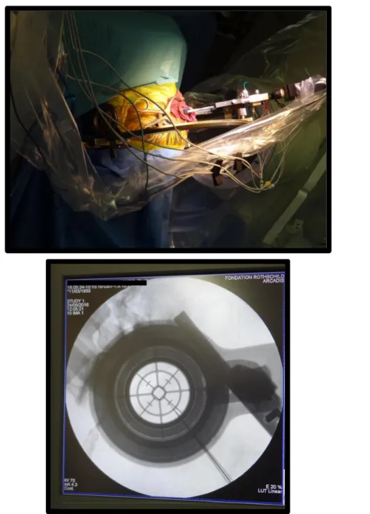 Figure 10  Chirurgie  implantatoire  d’électrodes  de  stimulation  cérébrale  profonde  au  niveau  du  noyau  sous-thalamique chez un patient atteint de la maladie de Parkinson