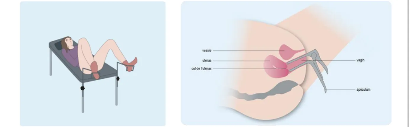 Figure 2 : A gauche : position pour un examen gynécologique ; à droite : position du spéculum  dans le vagin lors d’un frottis