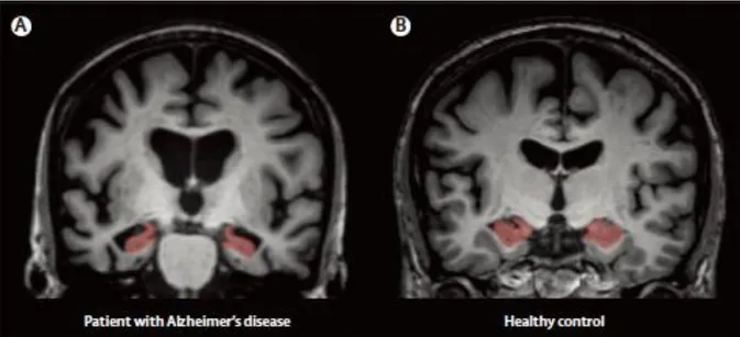 Figure  2 :  Images  obtenues  par  IRM  structurelle  à  haute  résolution  montrant  une  atrophie  hippocampique chez un patient atteint de la MA (A) par rapport à un témoin apparié en âge  (B)  (Teipel et al., 2015)