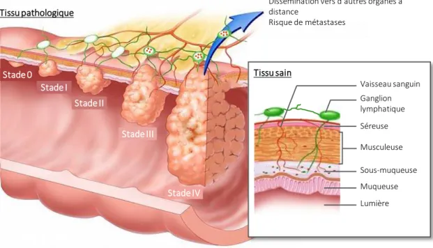 Figure  9  │  Stades  &amp;  classification  TNM  histopathologique  simplifiée  des  cancers  du  côlon  et  du  rectum